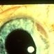 Ciliary Body Tumor Ciliary Body Tumor